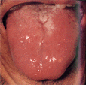 暗紅舌滑苔