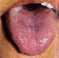 青紫裂紋舌