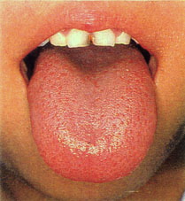 正常な舌
