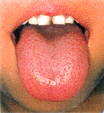 正常な舌